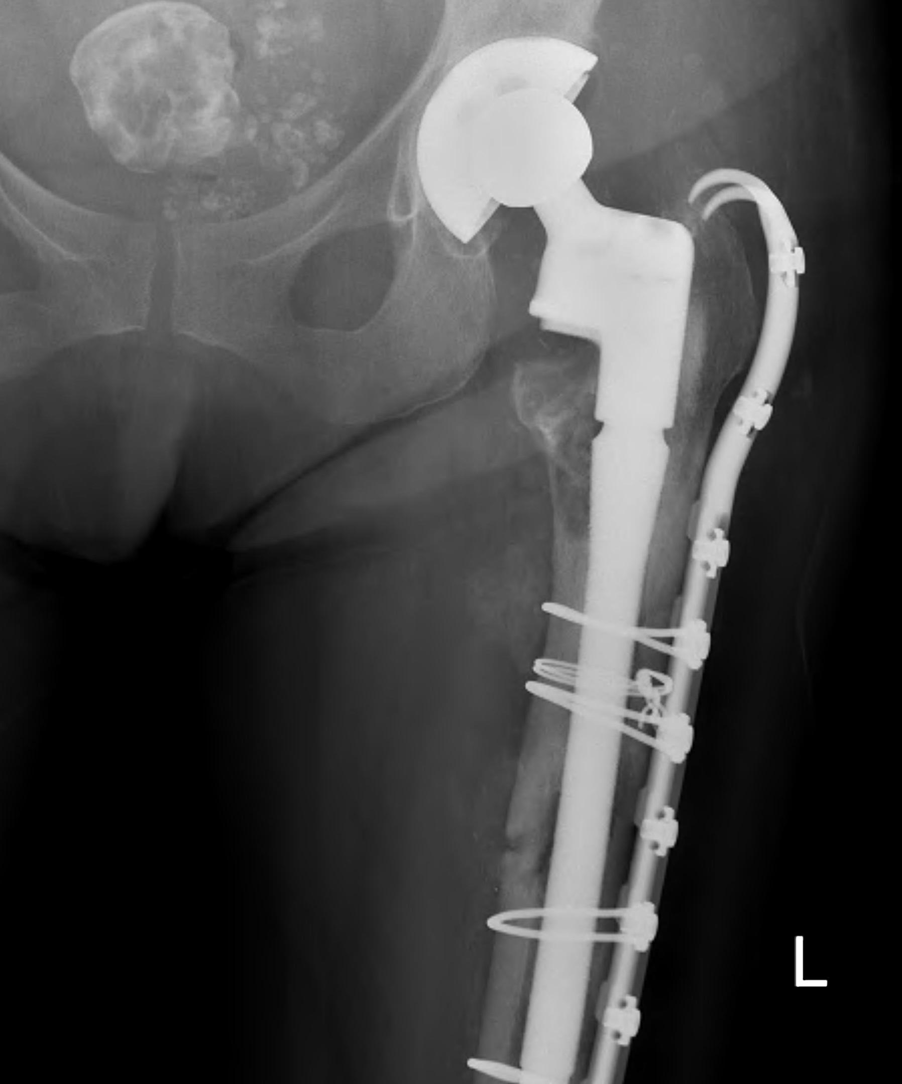 THR Fracture Long Stem Revision